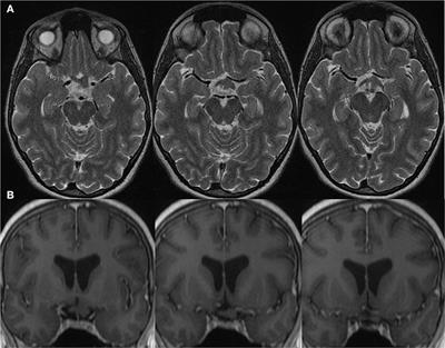 Homonymous Retinal Ganglion Cell Layer Atrophy With Asymptomatic Optic Tract Glioma in Neurofibromatosis Type I